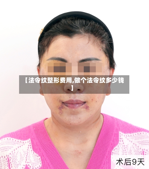 【法令纹整形费用,做个法令纹多少钱】